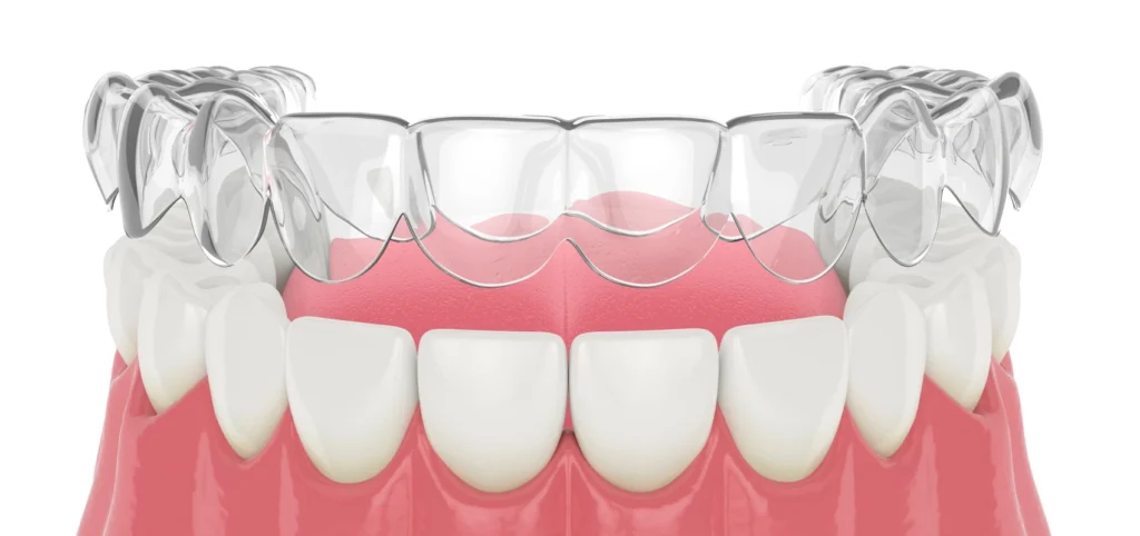 Orthodontiste enfants Bouillargues 30230 Aligneurs transparents