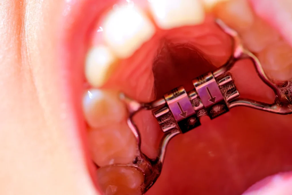 Orthodontie Enfant Bouillargues 30230