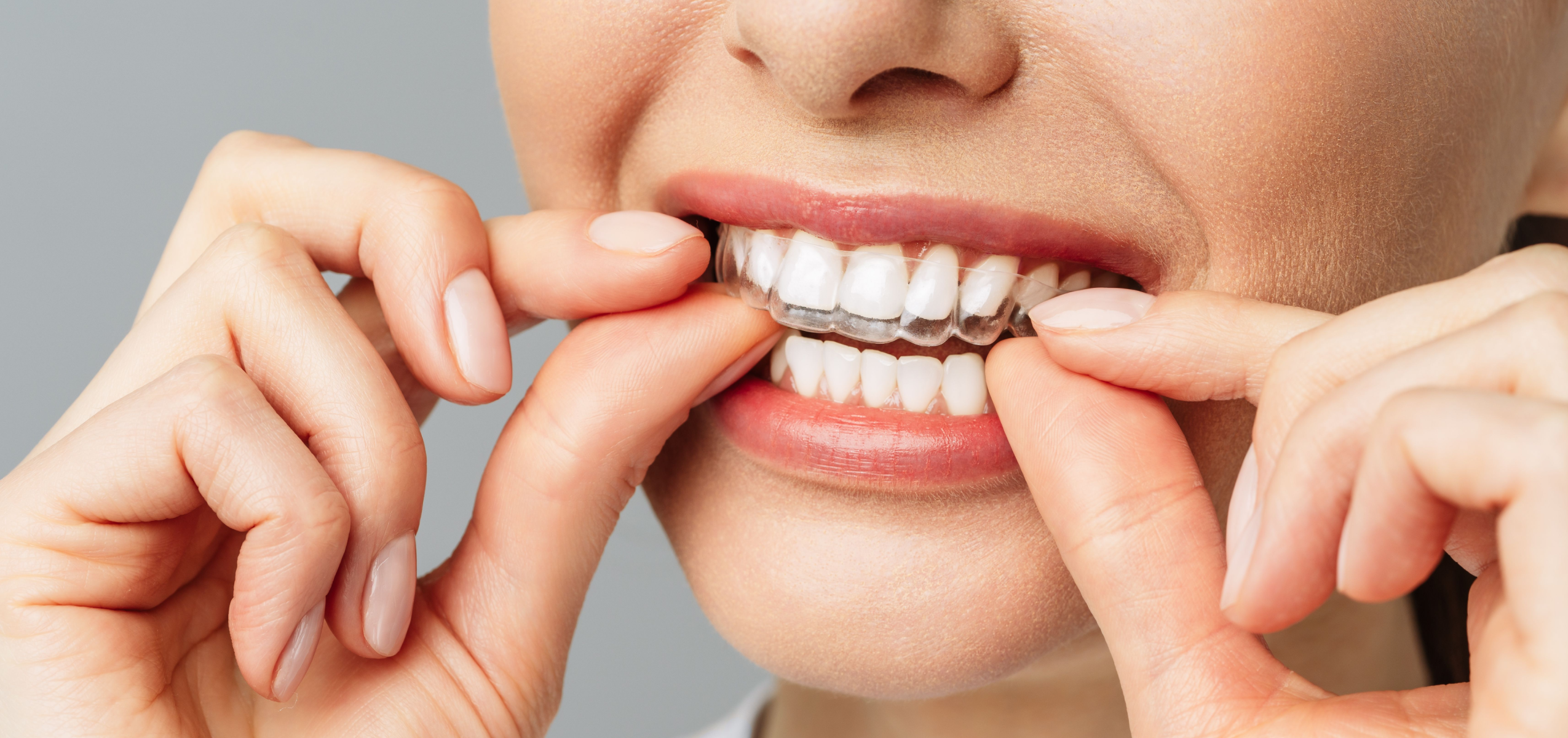 Orthodontiste Adultes Bouillargues 30230