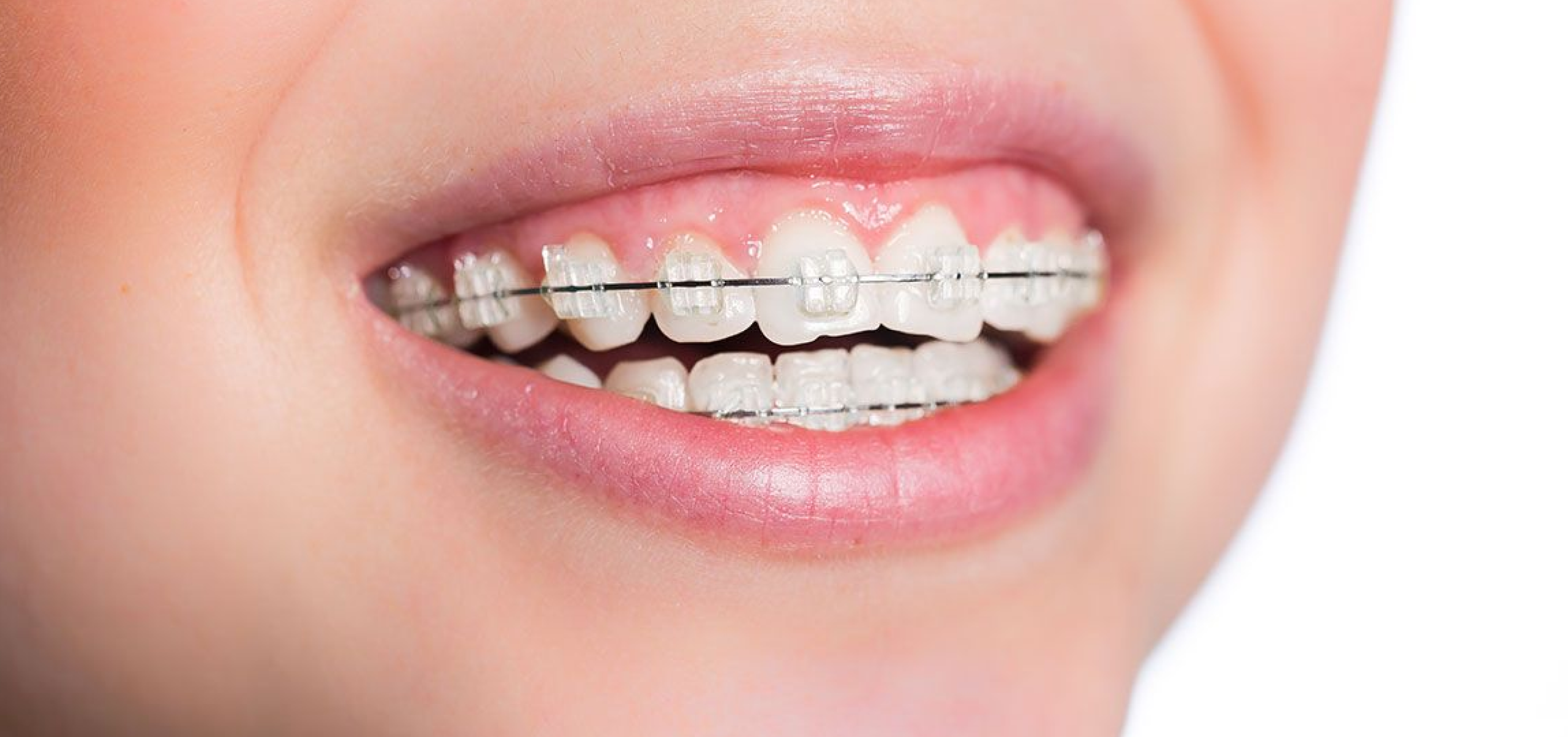 Orthodontiste enfants Bouillargues 30230