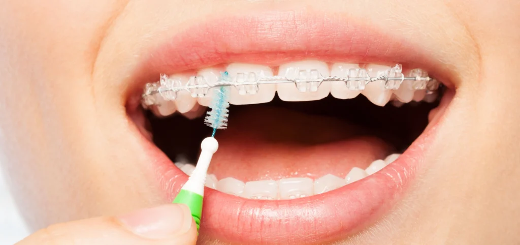 Hygiène bucco-dentaire et orthodontie