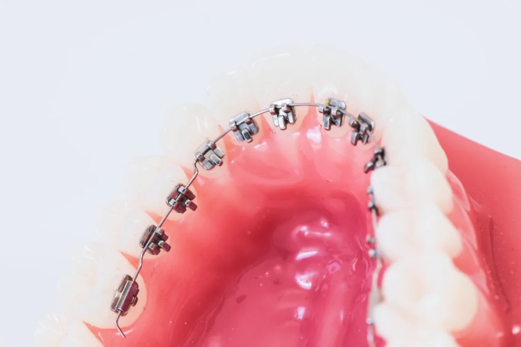 Orthodontiste adolescents Bouillargues Appareil lingual
