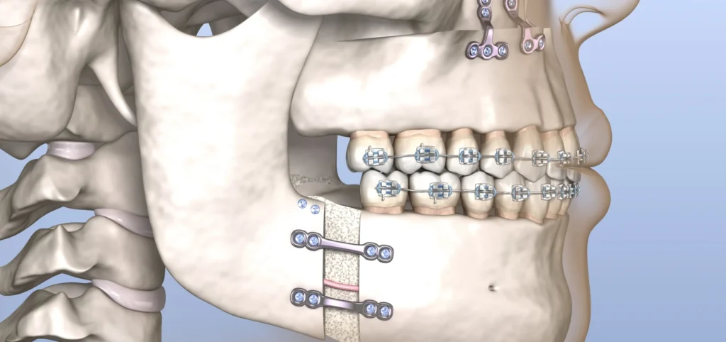 Chirurgie maxillo-faciale Orthodontie Adulte