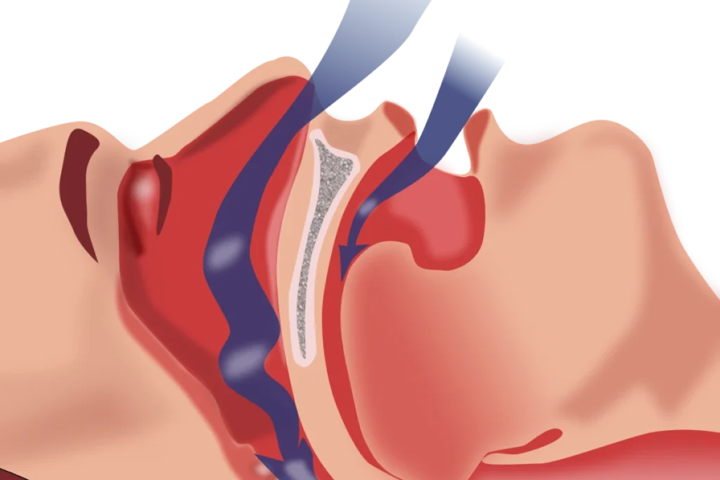 Apnée du sommeil & Orthodontie