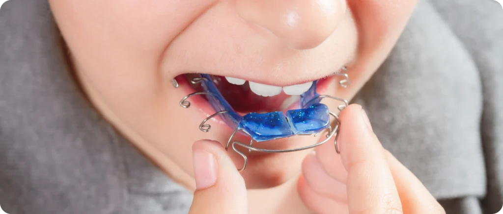 Enfant portant un appareil orthodontique amovible